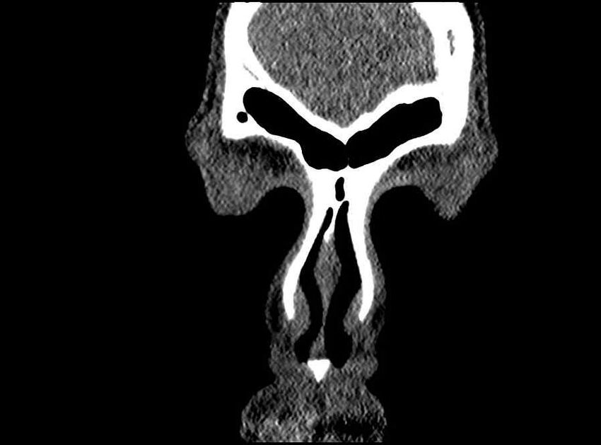 Arachnoid cyst- extremely large (Radiopaedia 68741-78450 Coronal bone window 75).jpg