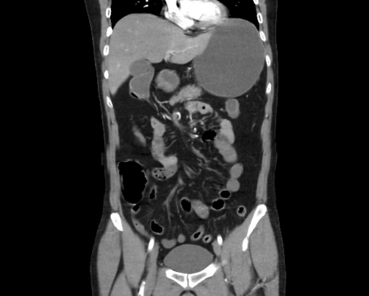 File:Arterial occlusive mesenteric ischemia (Radiopaedia 84641-100060 B 22).jpg