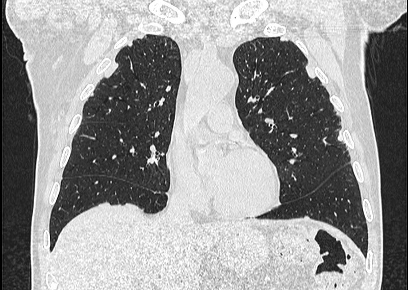 File:Asbestos pleural placques (Radiopaedia 57905-64872 Coronal lung window 112).jpg