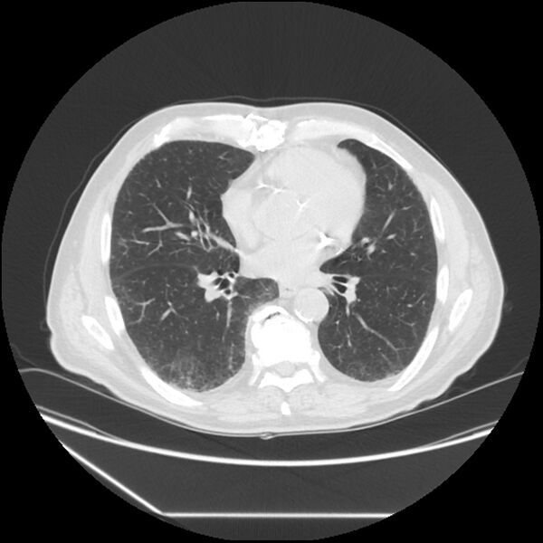 File:Asbestosis complicated by lung cancer (Radiopaedia 45834-50116 Axial lung window 40).jpg