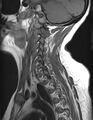 Astrocytoma - spinal cord (Radiopaedia 69769-79758 Sagittal T1 10).jpg