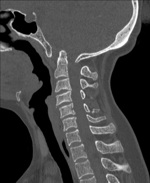 File:Atlanto-occipital assimilation with basilar invagination (Radiopaedia 70122-80188 Sagittal bone window 68).jpg