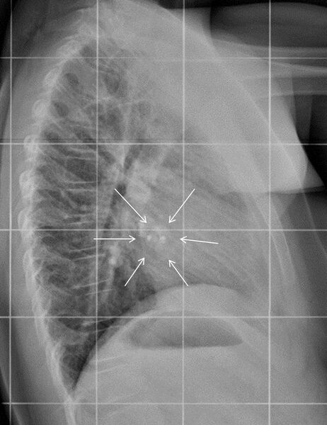 File:Atrial septal defect closure device (Radiopaedia 20923-20862 Lateral 1).jpg