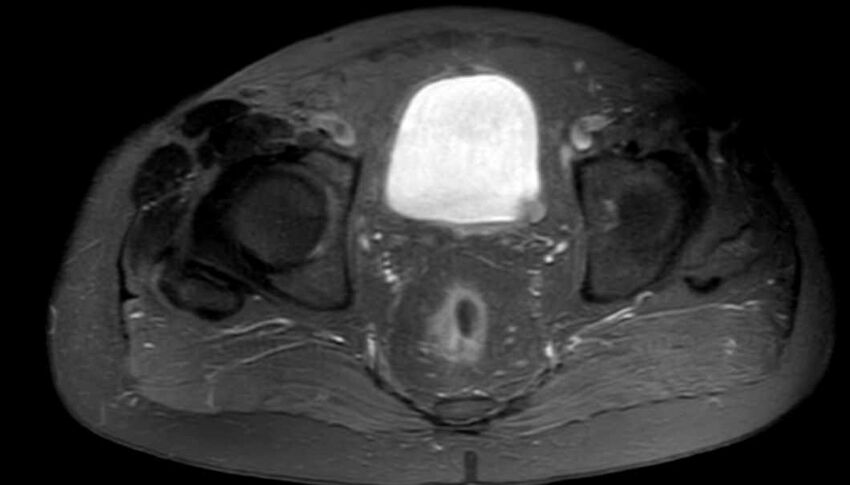 Atypical lipomatous tumor - thigh (Radiopaedia 68975-78734 Axial PD fat sat 96).jpg