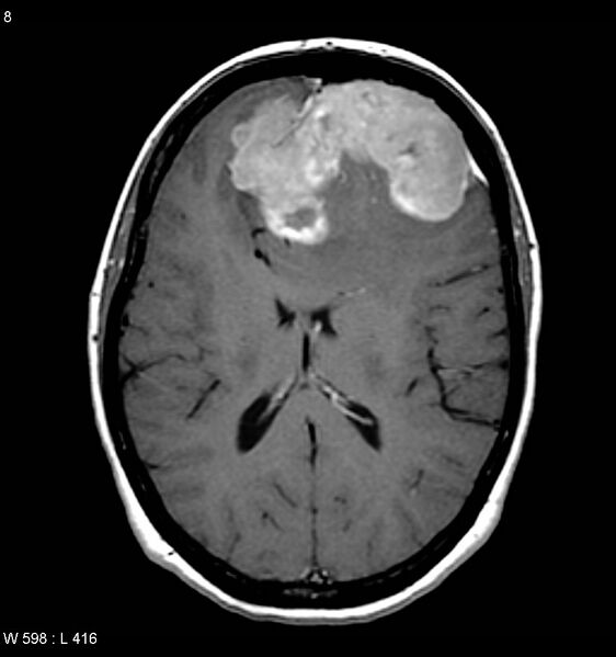 File:Atypical meningioma (WHO grade II) (Radiopaedia 7762-8586 D 4).jpg