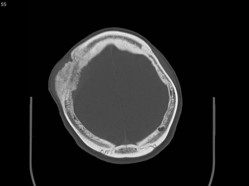 Atypical meningioma - intraosseous (Radiopaedia 64915-73867 Axial C+ bone window 55).jpg