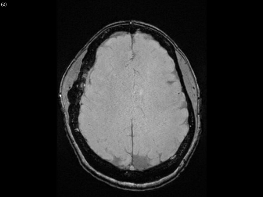 Atypical meningioma - intraosseous (Radiopaedia 64915-74572 Axial SWI 60).jpg