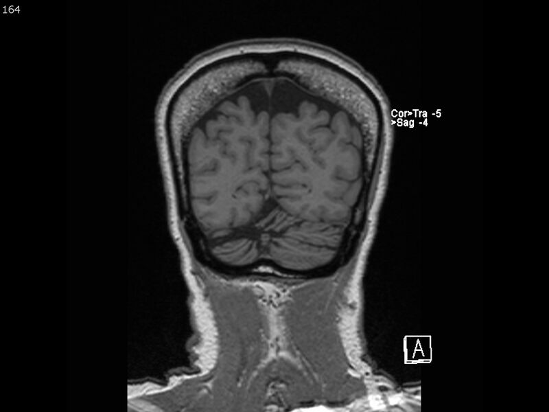 File:Atypical meningioma - intraosseous (Radiopaedia 64915-74572 Coronal T1 164).jpg