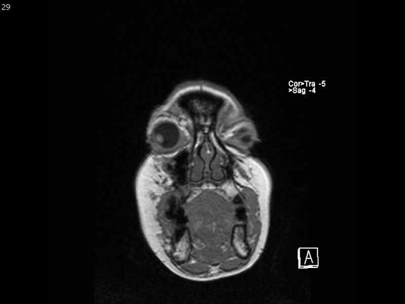 File:Atypical meningioma - intraosseous (Radiopaedia 64915-74572 Coronal T1 29).jpg