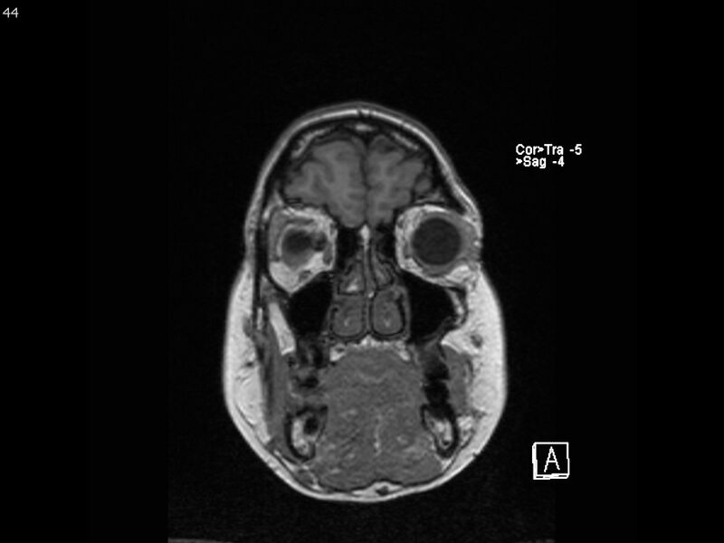 File:Atypical meningioma - intraosseous (Radiopaedia 64915-74572 Coronal T1 44).jpg