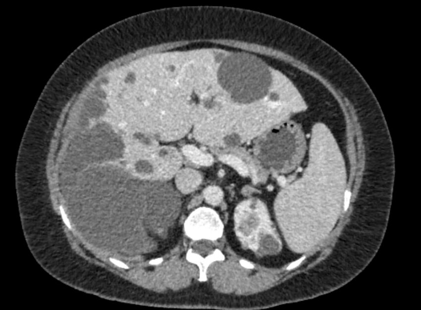 Autosomal dominant polycystic kidney disease (Radiopaedia 57124-64017 A 41).jpg