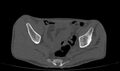 Avascular necrosis of the left hip (Radiopaedia 75068-86125 Axial bone window 6).jpg