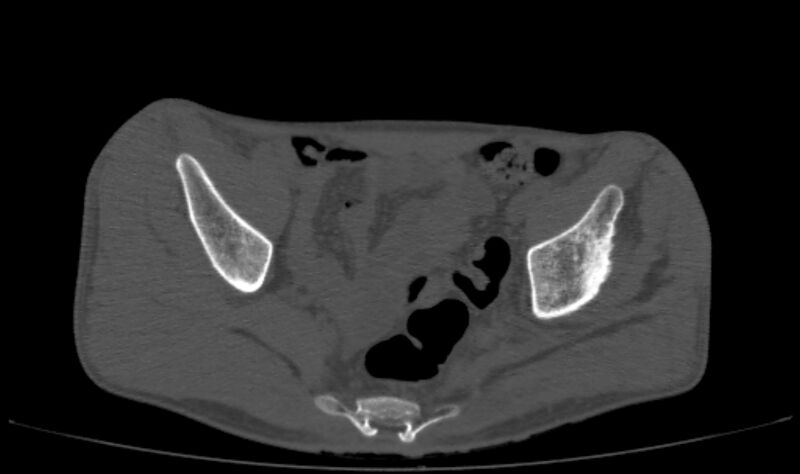 File:Avascular necrosis of the left hip (Radiopaedia 75068-86125 Axial bone window 6).jpg