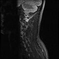 Axis fracture - MRI (Radiopaedia 71925-82375 Sagittal STIR 2).jpg