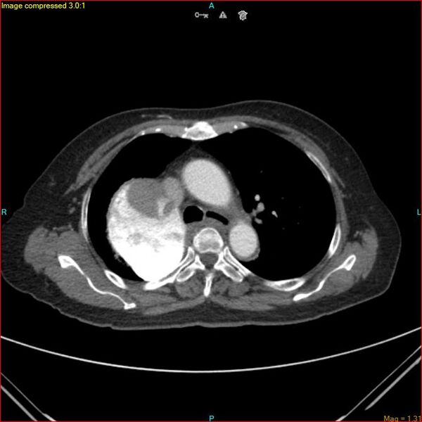 File:Azygos vein aneurysm (Radiopaedia 77824-90130 B 22).jpg