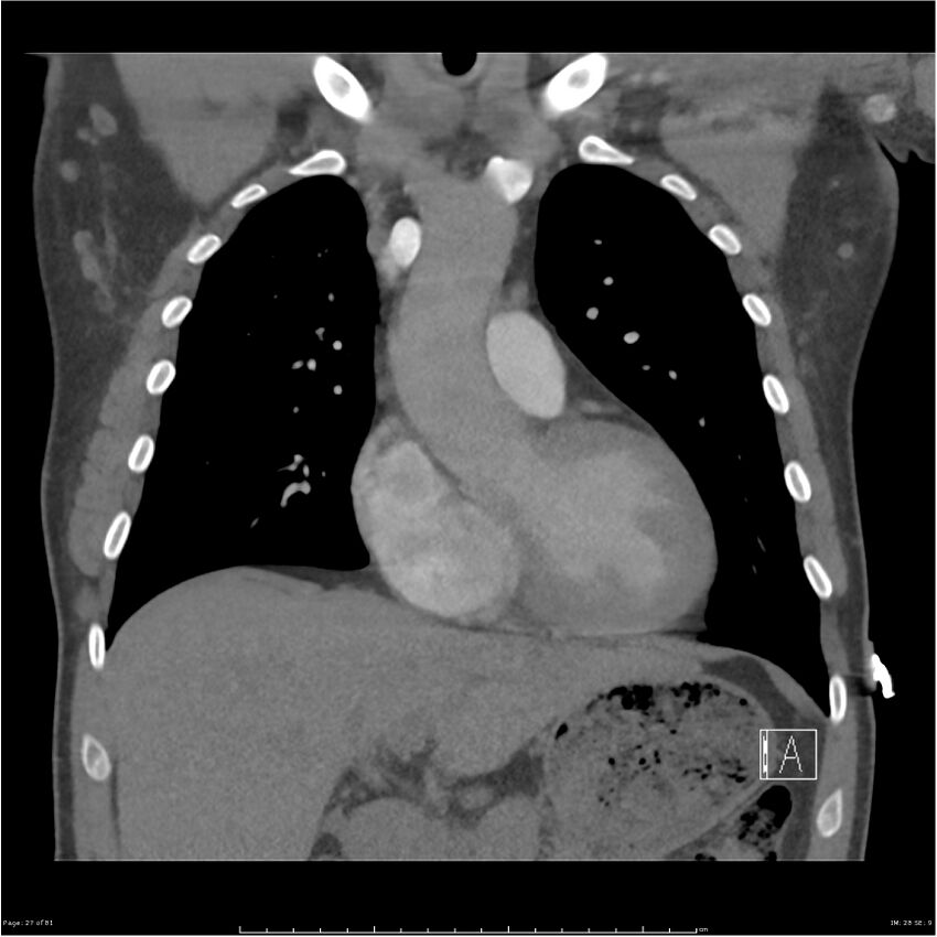 Azygos venous system anatomy (CT pulmonary angiography) (Radiopaedia 25928-26077 Coronal C+ CTPA 27).jpg