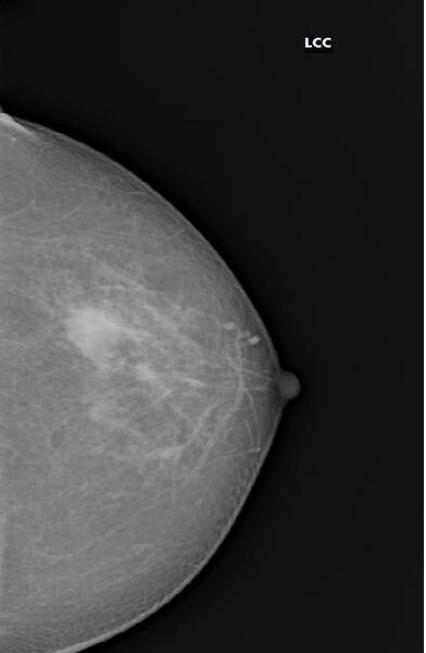 File:BIRADS II lesion - simple breast cyst (Radiopaedia 16526-16207 CC 1).jpg