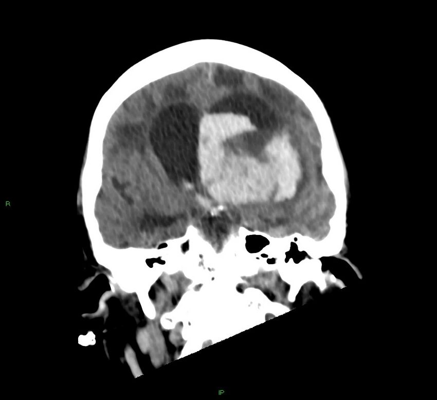 Basal ganglia hemorrhage (Radiopaedia 58766-65988 Coronal non-contrast 39).jpg