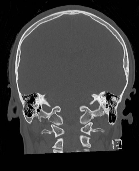 File:Base of skull fracture with bilateral Le Fort fractures (Radiopaedia 47094-51638 Coronal bone window 39).jpg