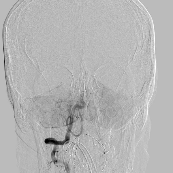 File:Basilar artery occlusion (Radiopaedia 33570-34668 RT VERT IC 20).png