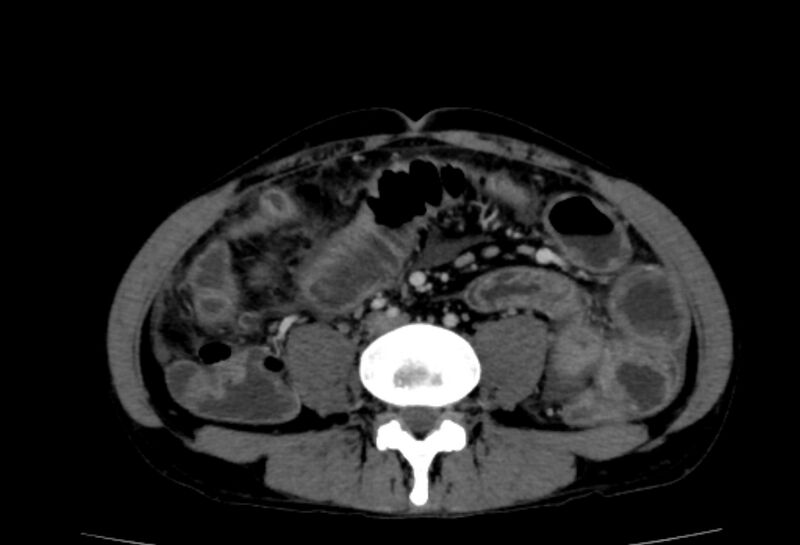 File:Behçet's disease- abdominal vasculitis (Radiopaedia 55955-62570 A 50).jpg