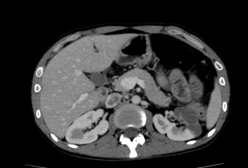 File:Behçet's disease. abdominal vasculitis (Radiopaedia 55955-62570 Axial 61).jpg