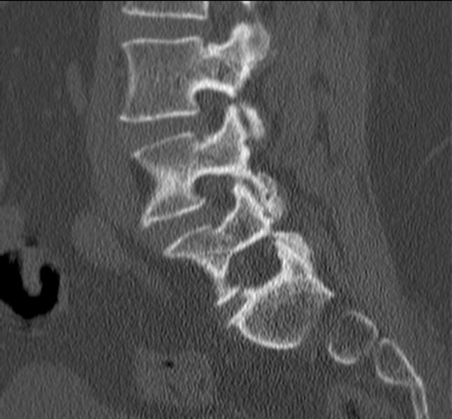 File:Bertolotti syndrome (Radiopaedia 24864-25128 Sagittal bone window 20).jpg