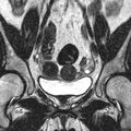 Bicornuate uterus (Radiopaedia 11104-11492 Coronal T2 6).jpg