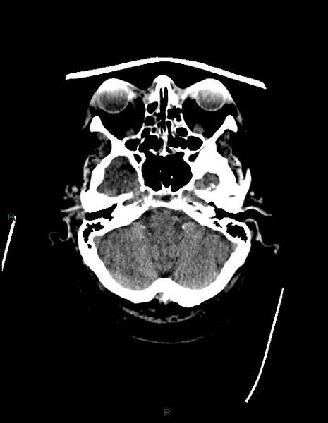File:Bilateral acute middle cerebral artery territory infarcts (Radiopaedia 77319-89401 Axial non-contrast 16).jpg