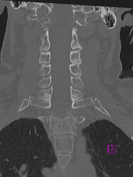 File:Bilateral atlanto-occipital assimilation (Radiopaedia 28350-28603 Coronal bone window 22).jpg