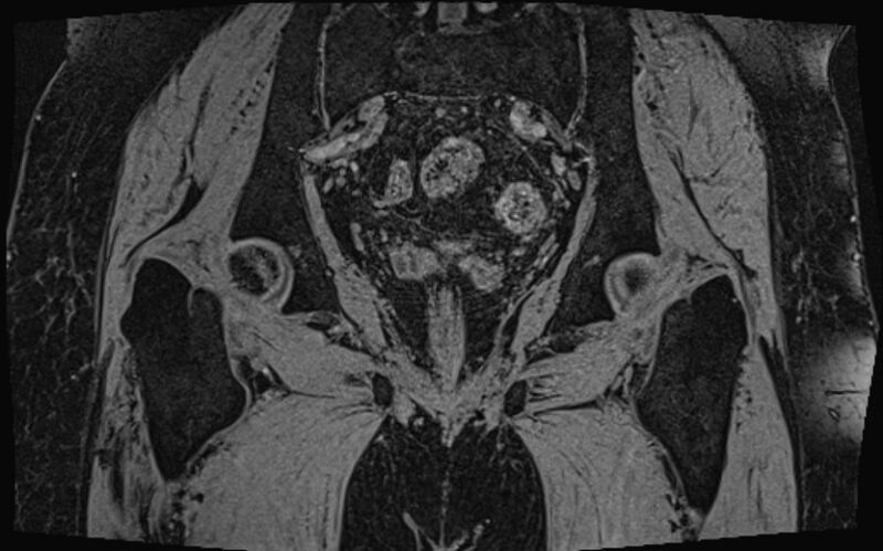 File:Bilateral avascular necrosis of femoral head (Radiopaedia 77116-89078 Coronal T2 we 16).jpg