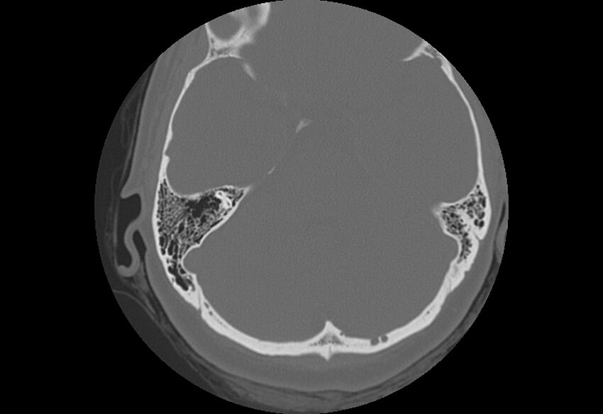 Bilateral otospongiosis (Radiopaedia 35447-36940 B 46).jpg