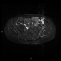 Bilateral ovarian fibroma (Radiopaedia 44568-48293 Axial STIR 8).jpg