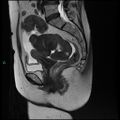 Bilateral ovarian fibroma (Radiopaedia 44568-48293 Sagittal T2 19).jpg