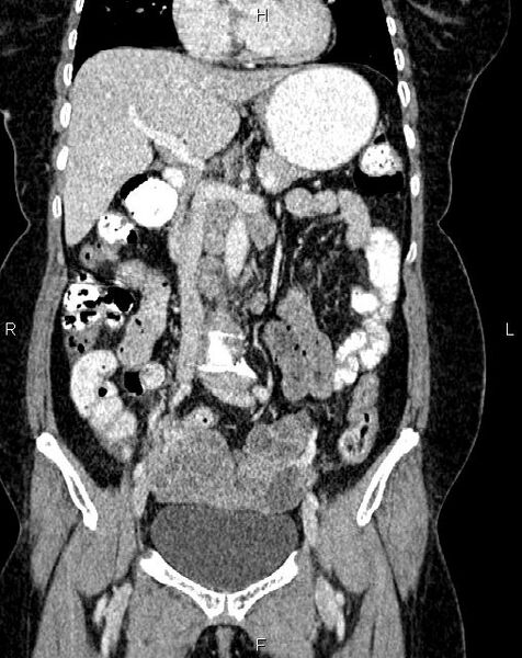 File:Bilateral ovarian serous cystadenocarcinoma (Radiopaedia 86062-101989 D 18).jpg