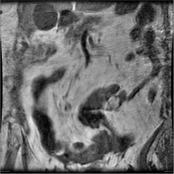 File:Bilateral psoas hematomas (Radiopaedia 24057-24280 B 22).jpg