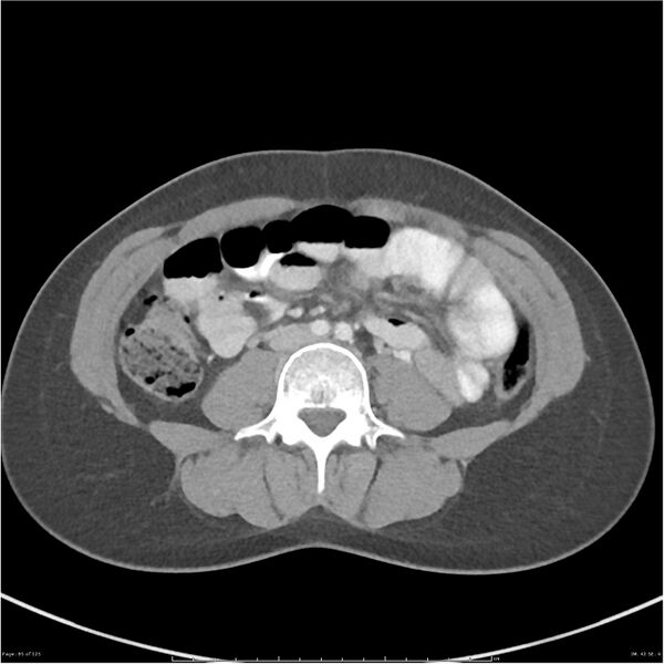 File:Bilateral ureteritis and cystitis (Radiopaedia 25340-25594 A 42).jpg