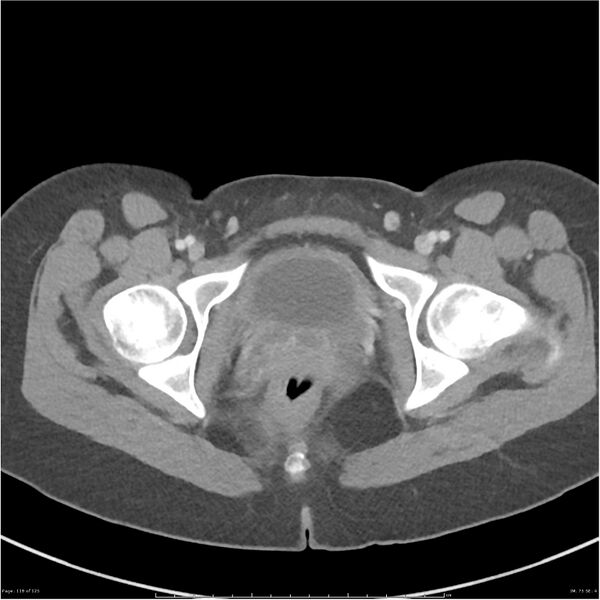 File:Bilateral ureteritis and cystitis (Radiopaedia 25340-25594 A 75).jpg