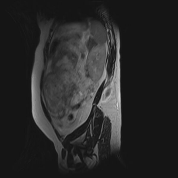 File:Bilobed placenta accreta (Radiopaedia 69648-79591 G 10).jpg