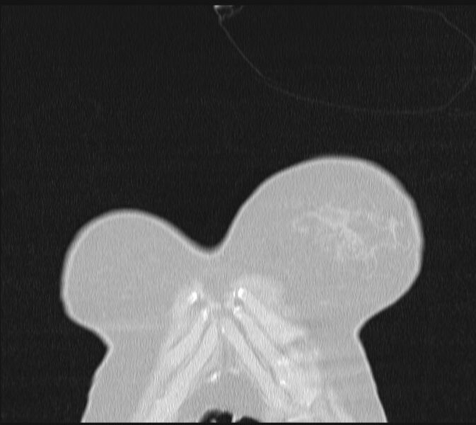 File:Boerhaave syndrome (Radiopaedia 45644-49799 Coronal lung window 2).jpg