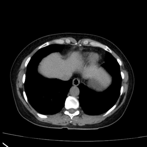 File:Bosniak renal cyst - type I (Radiopaedia 27479-27675 Axial non-contrast 8).jpg