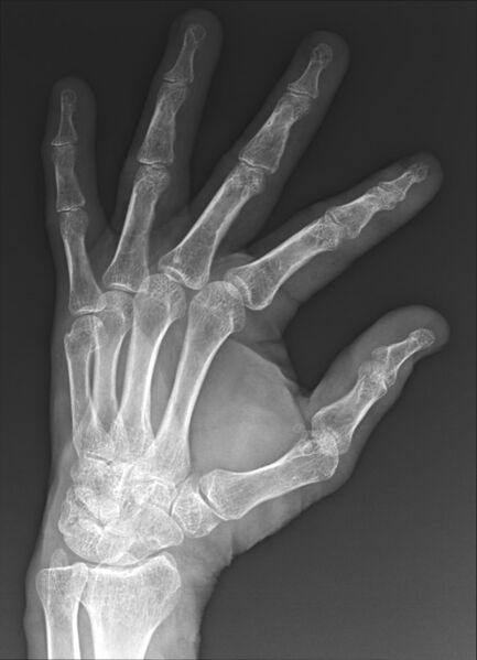 File:Boxer's fracture (Radiopaedia 67094-76431 Oblique 1).jpg