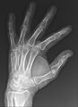 Boxer's fracture (Radiopaedia 67094-76431 Oblique 1).jpg