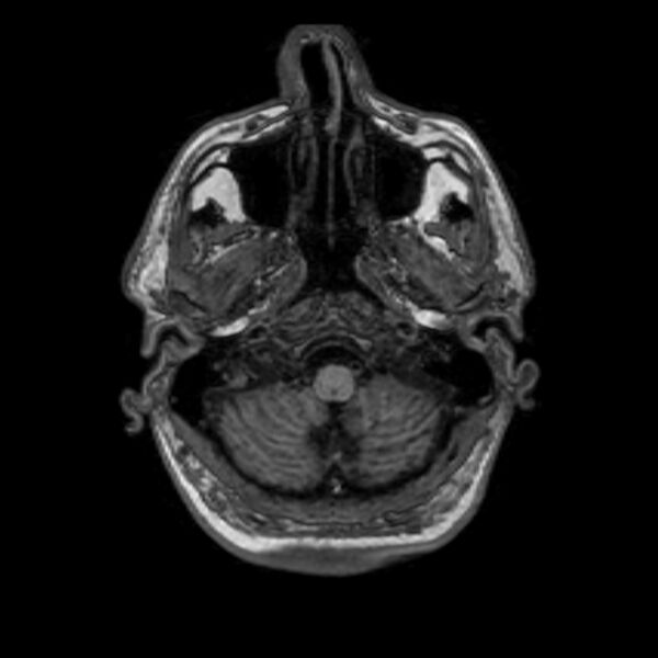 File:Brain abscess complicated by intraventricular rupture and ventriculitis (Radiopaedia 82434-96577 Axial T1 4).jpg