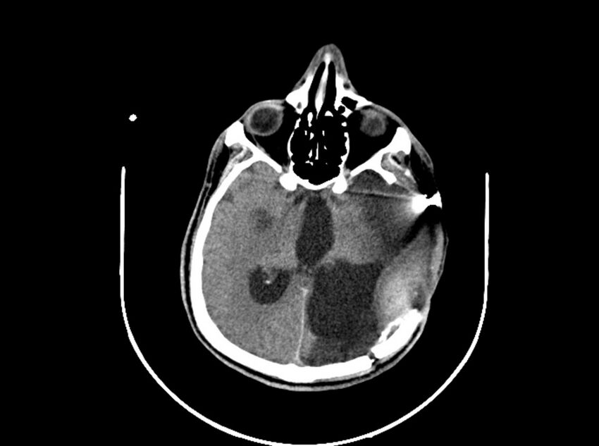 Brain injury by firearm projectile (Radiopaedia 82068-96088 A 121).jpg