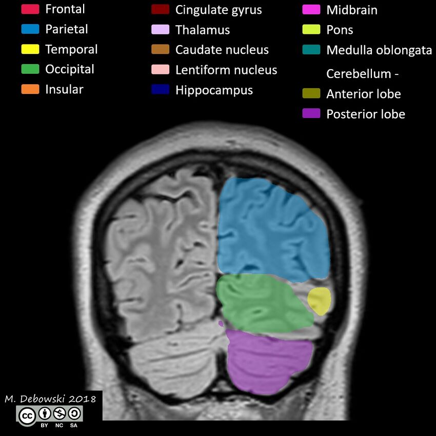 Brain lobes - annotated MRI (Radiopaedia 61691-69700 Coronal 60).JPG