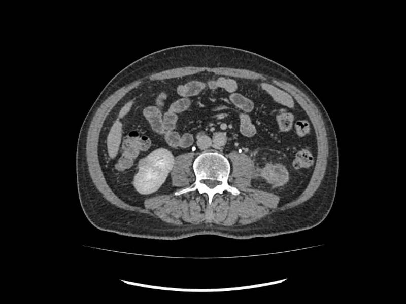 File:Brain metastases from renal cell carcinoma (Radiopaedia 42222-45328 Axial C+ delayed 151).jpg