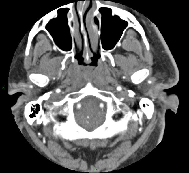 File:Brainstem hemorrhage (Radiopaedia 58794-66028 D 23).jpg
