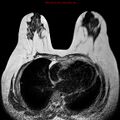 Breast carcinoma (multicentric multifocal in mammary Paget disease) (Radiopaedia 50966-56512 Axial T2 6).jpg