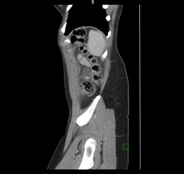 File:Broad ligament hernia (Radiopaedia 63260-71832 C 48).jpg